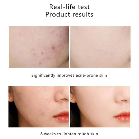 Ordinary Niacinamide 10% + Zinc 1% (Buy1 Get 1 Free)